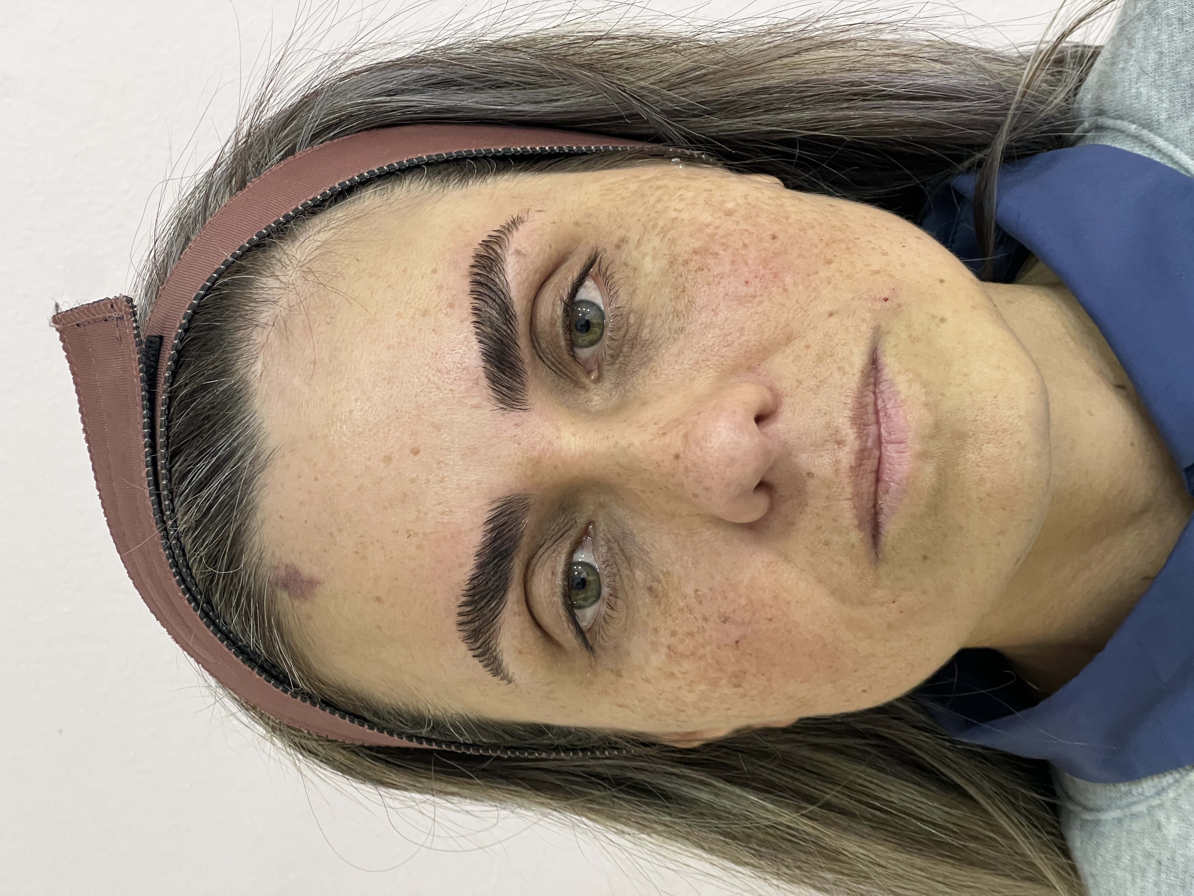 Nuze depois da harmonização facial